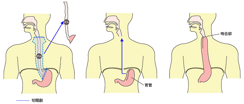 手術療法