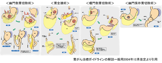 胃切除術