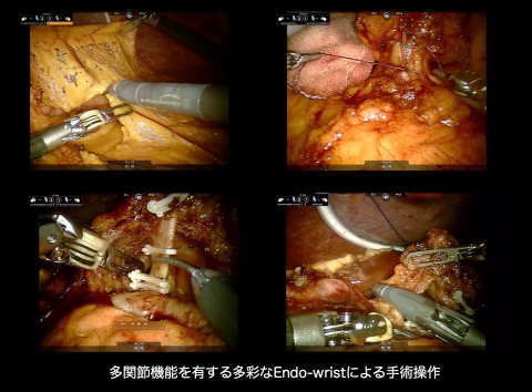 ロボット支援下手術